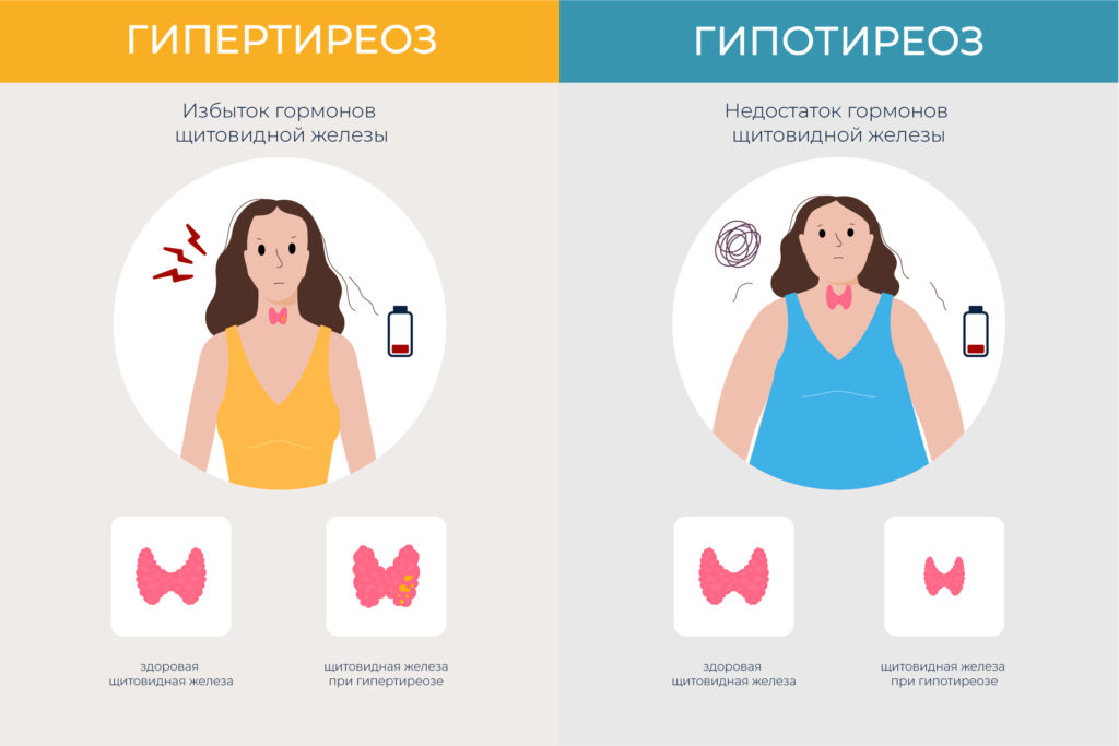 Гипертиреоз & Гипотиреоз