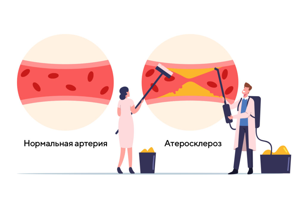 Состояние артерий
