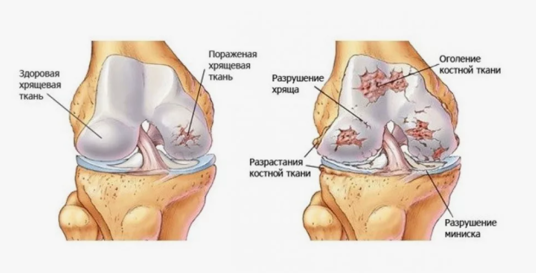 дегенеративные изменения в суставе